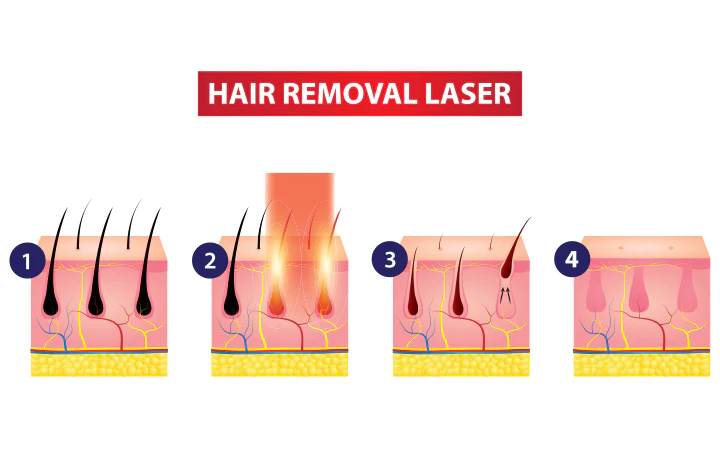 laser hair removal principle