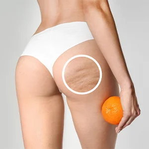 reduce cellulite