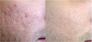 Acne scar removal