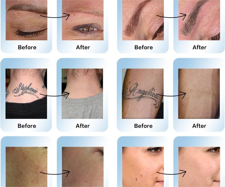 eyebrow tattoo removal laser machine